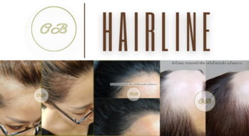 OB Hairline  1