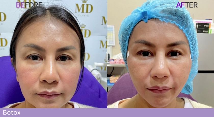 MD Clinic เอ็มดีคลินิก ขอนแก่น ฉีดโบท๊อกซ์ ร้อยไหม ฟิลเลอร์ ปรับรูปหน้า 6