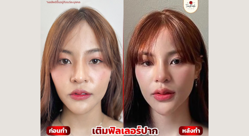 TeeRak Clinic ที่รักคลินิก ขอนแก่น ฟิลเลอร์ บท็อกซ์ ร้อยไหม ความงาม 14