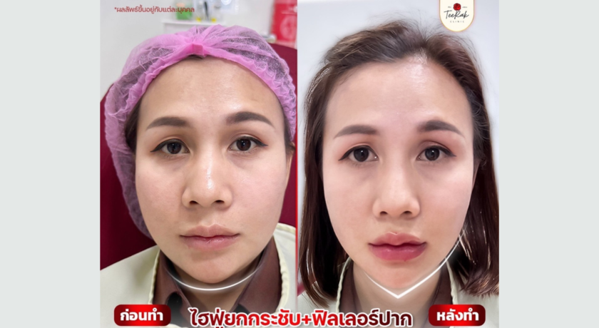 TeeRak Clinic ที่รักคลินิก ขอนแก่น ฟิลเลอร์ บท็อกซ์ ร้อยไหม ความงาม 15