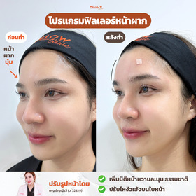 Mellow Clinic Mellow Clinic - เมลโล่ว คลินิก ปรับรูปหน้าและผิวสวย ย่านลาดพร้าว 71 IMG_2953