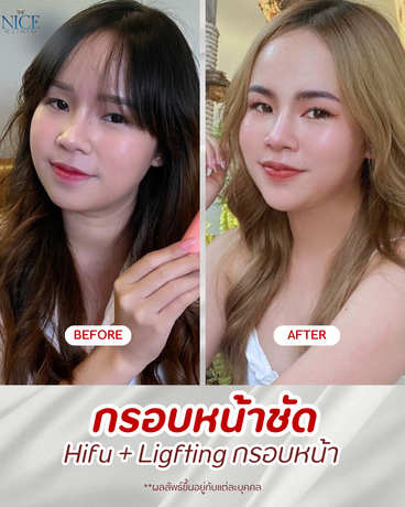The Nice Clinic  %E0%B8%AA%E0%B8%B5%E0%B8%84%E0%B8%A3%E0%B8%B5%E0%B8%A1_%E0%B8%AA%E0%B8%B5%E0%B8%99%E0%B9%89%E0%B8%B3%E0%B8%95%E0%B8%B2%E0%B8%A5_%E0%B9%80%E0%B8%A3%E0%B8%B5%E0%B8%A2%E0%B8%9A%E0%B8%87%E0%B9%88%E0%B8%B2%E0%B8%A2_%E0%B8%84%E0%B8%A7%E0%B8%B2%E0%B8%A1%E0%B8%87%E0%B8%B2%E0%B8%A1_%E0%B8%A3%E0%B8%B5%E0%B8%A7%E0%B8%B4%E0%B8%A7_Instagram_%E0%B9%82%E0%B8%9E%E0%B8%AA%E0%B8%95%E0%B9%8C_