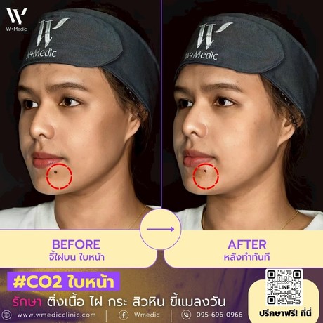 W+Medic Clinic ดับบลิว พลัส เมดิค คลินิค LINE_ALBUM_%E0%B8%A3%E0%B8%B5%E0%B8%A7%E0%B8%B4%E0%B8%A7_minor_%E0%B8%AB%E0%B8%B9%E0%B8%94_%E0%B9%84%E0%B8%9D_%E0%B8%84%E0%B8%B5%E0%B8%A5%E0%B8%AD%E0%B8%A2%E0%B8%94%E0%B9%8C%28%E0%B8%A3%E0%B8%AD%E0%B9%81%E0%B8%A2%E0%B8%81%29_250606_34