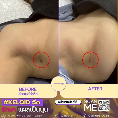 W+Medic Clinic ดับบลิว พลัส เมดิค คลินิค LINE_ALBUM_%E0%B8%A3%E0%B8%B5%E0%B8%A7%E0%B8%B4%E0%B8%A7_minor_%E0%B8%AB%E0%B8%B9%E0%B8%94_%E0%B9%84%E0%B8%9D_%E0%B8%84%E0%B8%B5%E0%B8%A5%E0%B8%AD%E0%B8%A2%E0%B8%94%E0%B9%8C%28%E0%B8%A3%E0%B8%AD%E0%B9%81%E0%B8%A2%E0%B8%81%29_250606_39