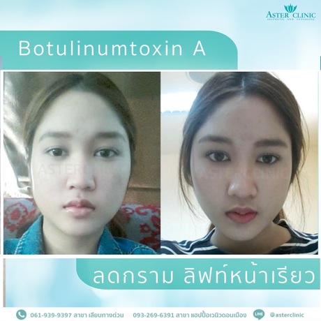 Aster clinic อัสเธอร์คลินิก- Happy Avenue donmuang แฮปปี้อเวนิวดอนเมือง สรงประภา  line_oa_chat_250624_160736