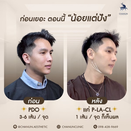 Chanun Aesthetic&Wellness  LINE_ALBUM_ads20_5_250715_4
