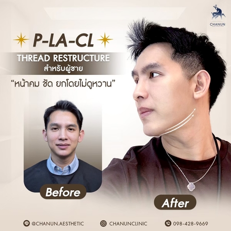 Chanun Aesthetic&Wellness  LINE_ALBUM_ads20_5_250715_5