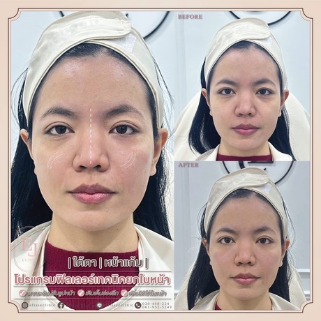 Enchante Clinic Enchante Clinic (อองชองเต คลินิก) image_picker_018539CC-D08E-42C2-BBE3-B20E1E9DDA06-6815-00000153D79686CF