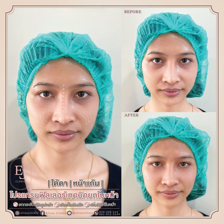 Enchante Clinic Enchante Clinic (อองชองเต คลินิก) image_picker_2E6FE4B2-DCFE-4ABE-8518-2F69D3C21048-6815-00000153D8B92580