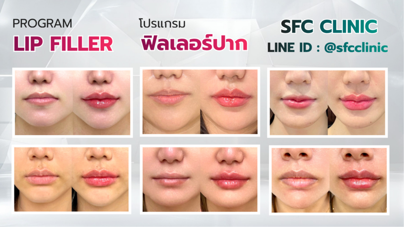 SFC Clinic (MRT Phahon Yothin) SFC Clinic - เอสเอฟซี คลินิก ความงามครบวงจร ใกล้ MRT พหลโยธิน image_picker_5B7B2782-4B1C-44D1-B5F8-FA030F19F104-1329-0000003B8E0FA554