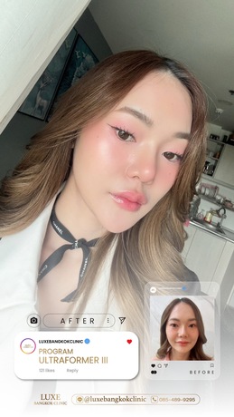 Luxe Bangkok Clinic (BTS Phahonyothin 24) Luxe Bangkok Clinic (BTS Phahonyothin 24) (มีสาขาเดียวเท่านั้น)  image_picker_FCF8A771-0A22-4F94-A261-81F07D6DE631-94420-00000C5AEFC02E49