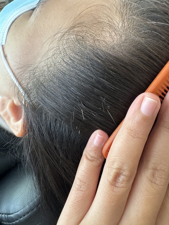 Service for Plucking Gray Hair Plucking Gray Hair Service - รับถอนผมหงอก พระราม 3 ซอยเฉลิมนิมิต 10 image_picker_13ABC8D4-273E-4037-A3E0-18AA324F9120-18576-000004A3CF135CED