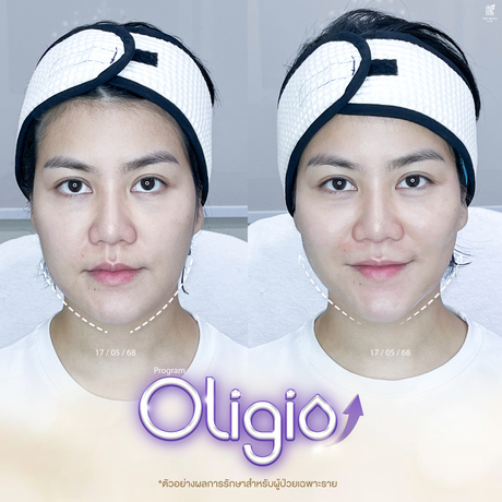 The Keith Clinic เดอะคีธคลินิก Card-Message-Review-Oligio-%E0%B8%A5%E0%B8%87-Line--1_%281%29