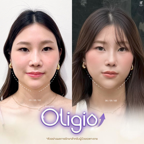 The Keith Clinic เดอะคีธคลินิก Card-Message-Review-Oligio-%E0%B8%A5%E0%B8%87-Line-3_%281%29