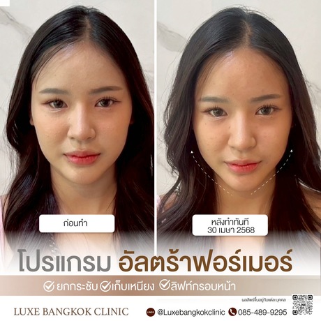 Luxe Bangkok Clinic (BTS Phahonyothin 24) Luxe Bangkok Clinic (BTS Phahonyothin 24) (มีสาขาเดียวเท่านั้น)  image_picker_FD63A2D6-2910-4100-9449-46AA6E7FE8A6-67356-00000813FF1DD726