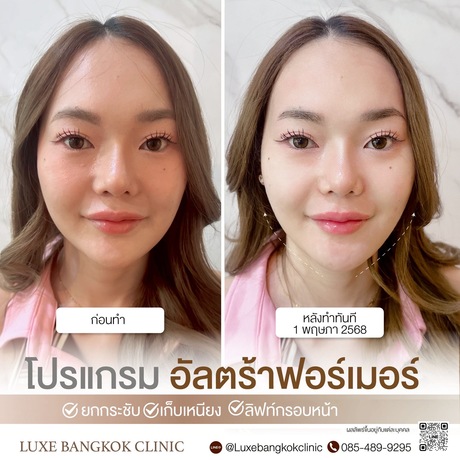 Luxe Bangkok Clinic (BTS Phahonyothin 24) Luxe Bangkok Clinic (BTS Phahonyothin 24) (มีสาขาเดียวเท่านั้น)  image_picker_BB3F025B-F461-4D01-A62A-B37962A24C6B-67356-00000813FEE8C1C9