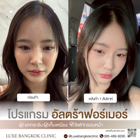 Luxe Bangkok Clinic (BTS Phahonyothin 24) Luxe Bangkok Clinic (BTS Phahonyothin 24) (มีสาขาเดียวเท่านั้น)  image_picker_2BF5E33C-5059-4346-B187-107A998F4980-67356-00000813FF6CE2BE