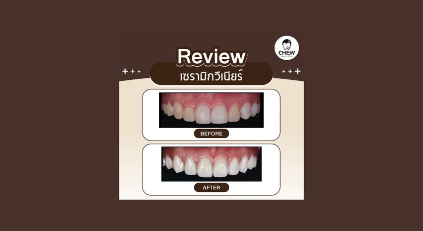 Chew Dental Clinic Chew Dental Clinic - คลินิกทันตกรรมชิว ทาวน์อินทาวน์ ลาดพร้าว 94 5