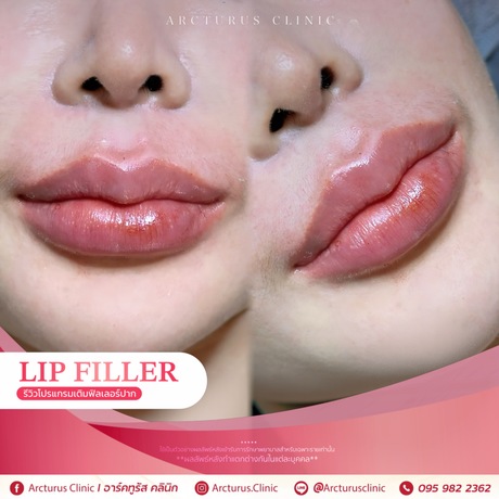 Arcturus Clinic Arcturus Clinic - อาร์คทูรัส คลินิก บริการความงามครบวงจร ย่านพัฒนาการ image_picker_87B4354B-2553-452C-A2F1-073855224C93-16095-000004CFEFB76FD7