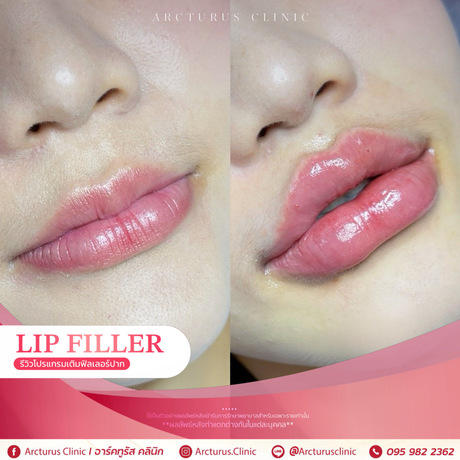 Arcturus Clinic Arcturus Clinic - อาร์คทูรัส คลินิก บริการความงามครบวงจร ย่านพัฒนาการ image_picker_34A27452-9DFC-481A-BC8D-5AE9D7F721B4-16095-000004CFF0A9AA57