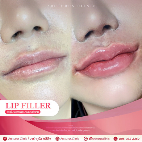Arcturus Clinic Arcturus Clinic - อาร์คทูรัส คลินิก บริการความงามครบวงจร ย่านพัฒนาการ image_picker_699D5730-5E82-4EF5-9B62-CA2B3645D6FC-16095-000004CFEFC4B006