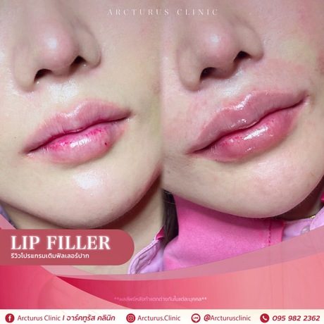 Arcturus Clinic Arcturus Clinic - อาร์คทูรัส คลินิก บริการความงามครบวงจร ย่านพัฒนาการ image_picker_1FCE9B2F-C09E-4109-A1C2-D92E9E57107F-16095-000004CFF0F70DEF