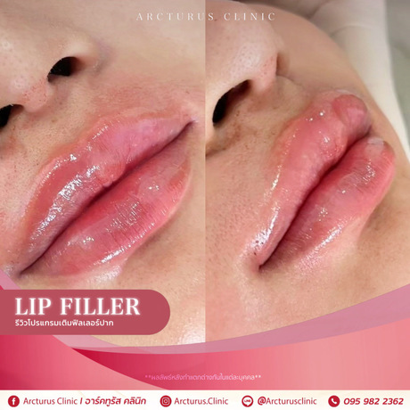 Arcturus Clinic Arcturus Clinic - อาร์คทูรัส คลินิก บริการความงามครบวงจร ย่านพัฒนาการ image_picker_18362015-3095-4491-B3D2-58E7A3BD7202-16095-000004CFF3C39973