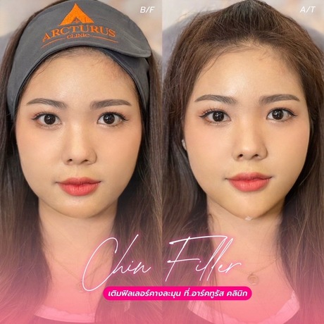 Arcturus Clinic Arcturus Clinic - อาร์คทูรัส คลินิก บริการความงามครบวงจร ย่านพัฒนาการ image_picker_EAC44290-0212-460D-AC6E-349B84258B15-16095-000004D39BE0FE85