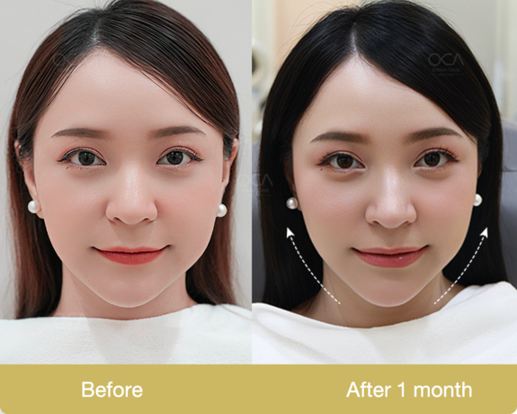 Edition Clinic (Marche' Thonglor) เอดิชั่น คลินิก (มาร์เช่ ทองหล่อ) Review02