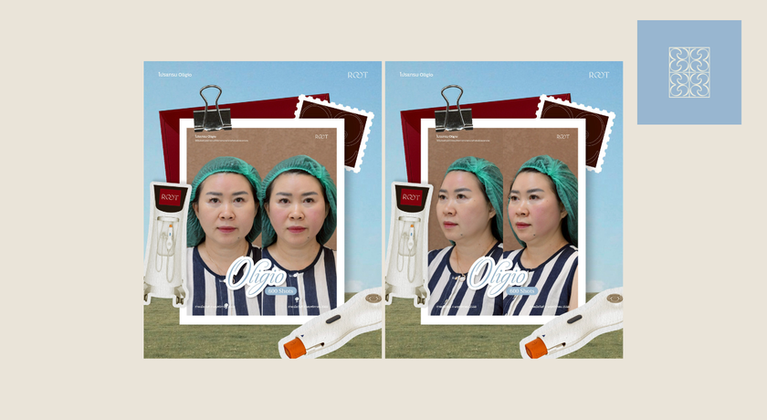 Root Clinic (CDC Zone L4 Floor 2) Root Clinic – รูท คลินิก ยกกระชับ ปรับรูปหน้า CDC เลียบด่วนรามอินทรา 8