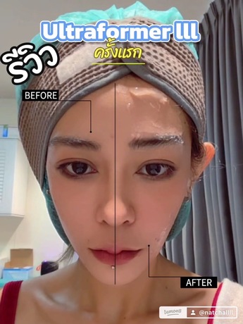 Luxe Bangkok Clinic (BTS Phahonyothin 24) Luxe Bangkok Clinic (BTS Phahonyothin 24) (มีสาขาเดียวเท่านั้น)  image_picker_79CE6F4D-6963-4722-B6FD-CBD43E8F1579-39121-00000F4F95B4E349