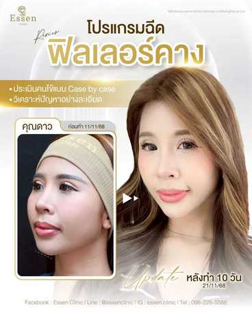 Essen Clinic Essen Clinic - เอสเซนคลินิก ปรับรูปหน้าเฉพาะบุคคล ย่านปากเกร็ด scaled_1000129215