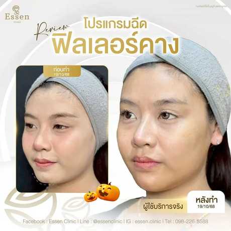 Essen Clinic Essen Clinic - เอสเซนคลินิก ปรับรูปหน้าเฉพาะบุคคล ย่านปากเกร็ด scaled_1000129220