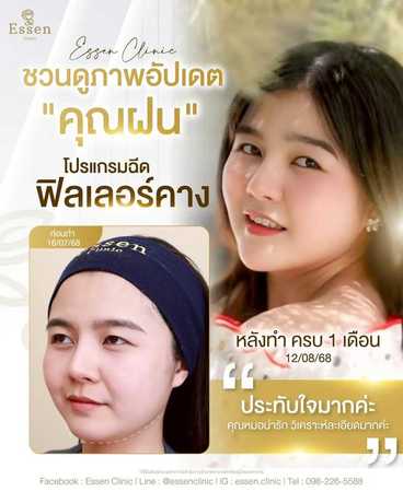 Essen Clinic Essen Clinic - เอสเซนคลินิก ปรับรูปหน้าเฉพาะบุคคล ย่านปากเกร็ด scaled_1000129223