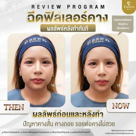 Essen Clinic Essen Clinic - เอสเซนคลินิก ปรับรูปหน้าเฉพาะบุคคล ย่านปากเกร็ด scaled_1000129232