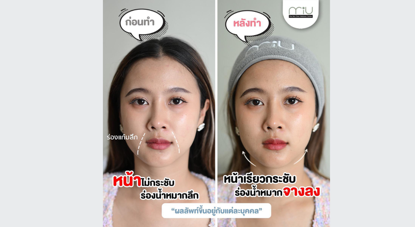 The MiU Wellbeing Clinic (Bangna Branch) The MiU Wellbeing Clinic (Bangna Branch) – ดิ มิว เวลบีอิ้ง คลินิก ความงาม บางนา 9