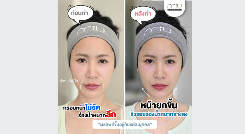 The MiU Wellbeing Clinic (Bangna Branch) The MiU Wellbeing Clinic (Bangna Branch) – ดิ มิว เวลบีอิ้ง คลินิก ความงาม บางนา 8
