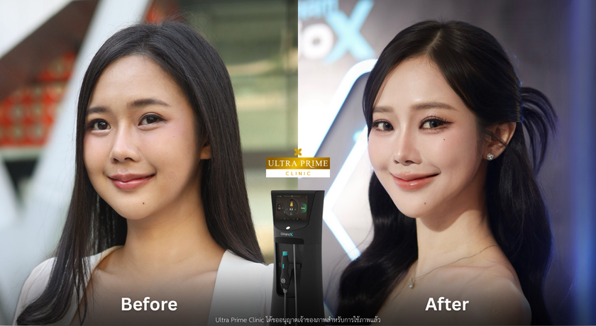 Ultra Prime Clinic Ultra Prime Clinic – อัลตร้า ไพรม์ คลินิกเวชกรรม ยกกระชับ ชิดลม 7