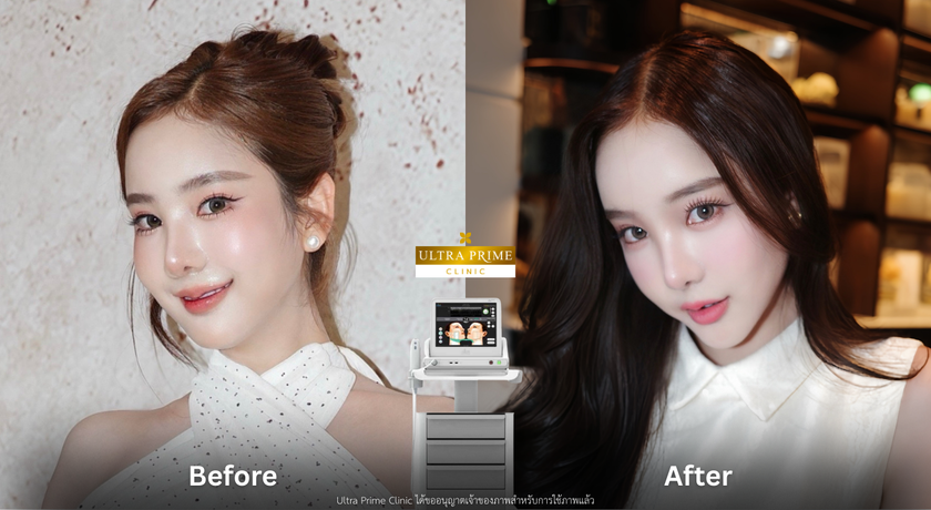 Ultra Prime Clinic Ultra Prime Clinic – อัลตร้า ไพรม์ คลินิกเวชกรรม ยกกระชับ ชิดลม 6