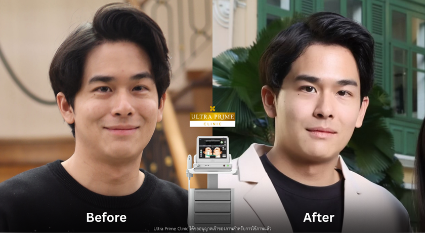 Ultra Prime Clinic Ultra Prime Clinic – อัลตร้า ไพรม์ คลินิกเวชกรรม ยกกระชับ ชิดลม 8