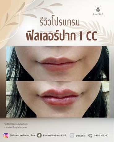 Eluceat Wellness Clinic Eluceat Wellness Clinic – เอลูเชต เวลเนส คลินิก ย่านลาดพร้าว image_picker_04B2EBD5-A00B-4DA8-BEB4-BFBC9814FF2E-16313-000005E28D1B9628