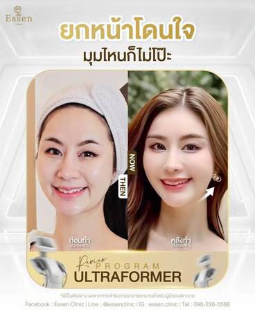 Essen Clinic Essen Clinic - เอสเซนคลินิก ปรับรูปหน้าเฉพาะบุคคล ย่านปากเกร็ด line_oa_chat_260210_105816