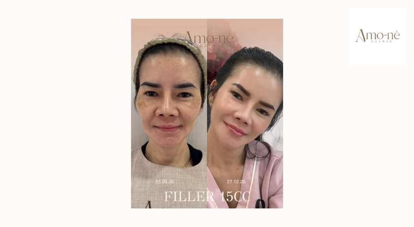 Amo-nè Clinic (Phetchaburi Soi 15, BTS Ratchathewi) (Amone Clinic) Amo-nè Clinic – อาโมเน่ คลินิก ความงามย่านเพชรบุรี 15 30