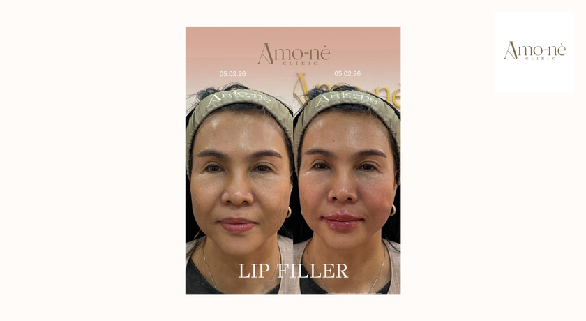 Amo-nè Clinic (Phetchaburi Soi 15, BTS Ratchathewi) (Amone Clinic) Amo-nè Clinic – อาโมเน่ คลินิก ความงามย่านเพชรบุรี 15 34