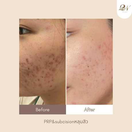 2N Clinic 2N Clinic - ทูเอ็นคลินิก เสริมความงาม เชียงใหม่ scaled_1000001478