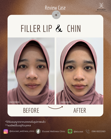 Eluceat Wellness Clinic Eluceat Wellness Clinic – เอลูเชต เวลเนส คลินิก ย่านลาดพร้าว image_picker_31889CBC-5906-4622-BCA7-D828A41B6E36-24863-000009A25E2F5B85