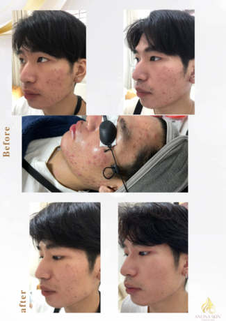 B Anona Skin B Anona Skin - บี อโณณา สกิน คลินิกรักษาสิว เชียงใหม่ image_picker_5E004D29-12E0-44AD-B935-562E6301CFD7-65102-000019ECF8C483C8