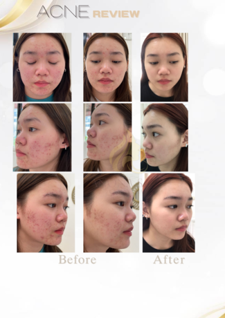 B Anona Skin B Anona Skin - บี อโณณา สกิน คลินิกรักษาสิว เชียงใหม่ image_picker_7FFED7E3-C177-403B-BF03-55301492F37A-65102-000019ECFC476B14