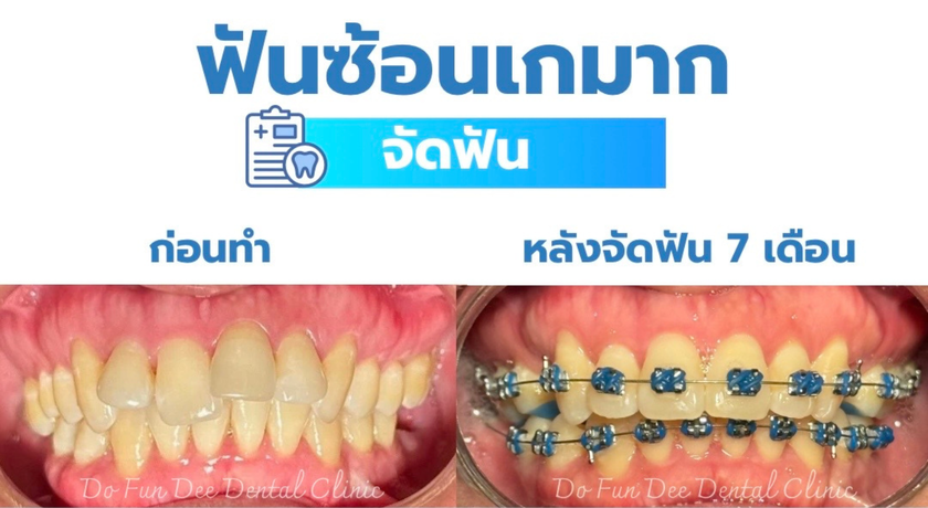 Do Fun Dee Dental Clinic Do Fun Dee Dental Clinic - คลินิกทันตกรรมดูฟันดี ทำฟันครบวงจรชลบุรี 6