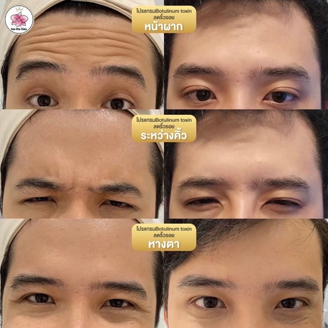 Nan-Cho Clinic (MRT Wat Mangkon Exit 3) Nan-Cho Clinic (MRT Wat Mangkon Exit 3) - นันโช่ คลินิก ความงามระดับมืออาชีพ ย่านเยาวราช image_picker_26D2DF76-78DF-41C3-AABB-FEA801110413-3659-000000D2F54B2131
